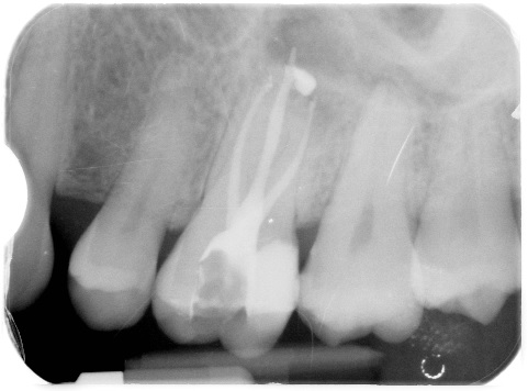 Upper molar root canal case